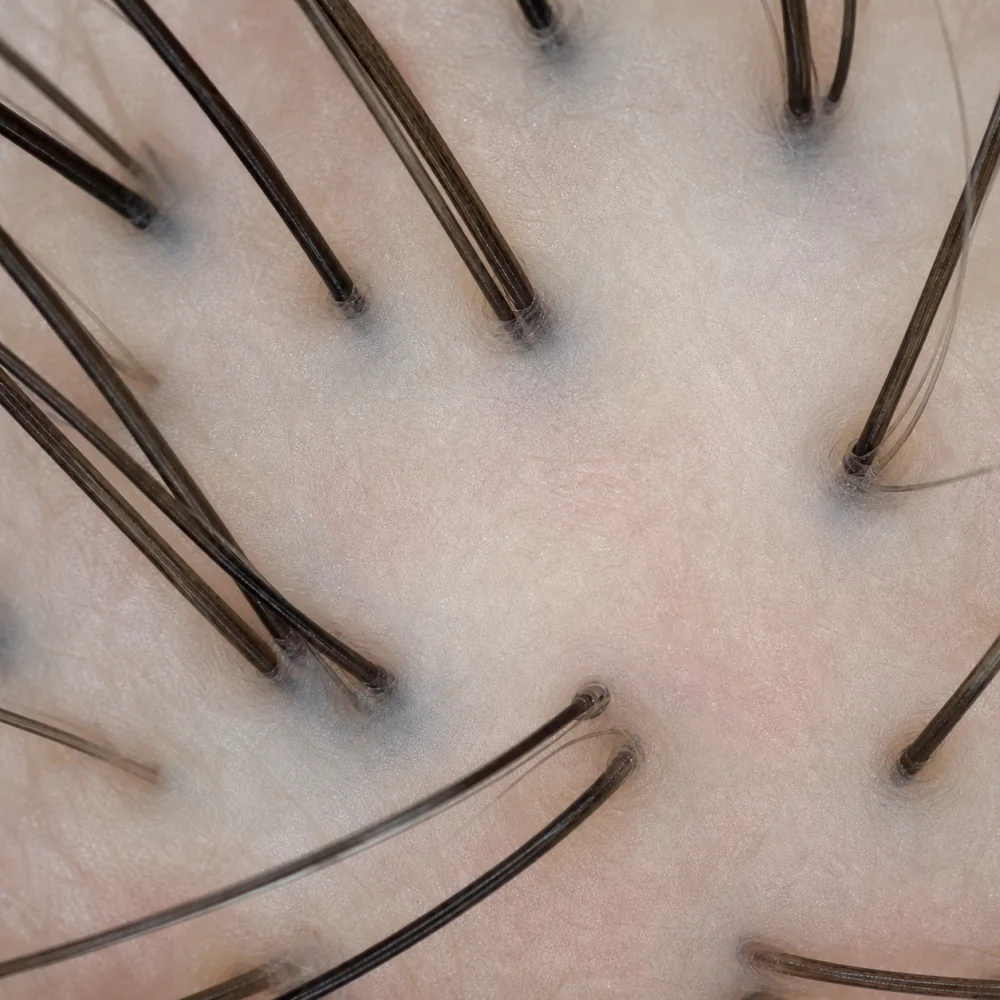 Illustrative after view of the same scalp area under 200x magnification