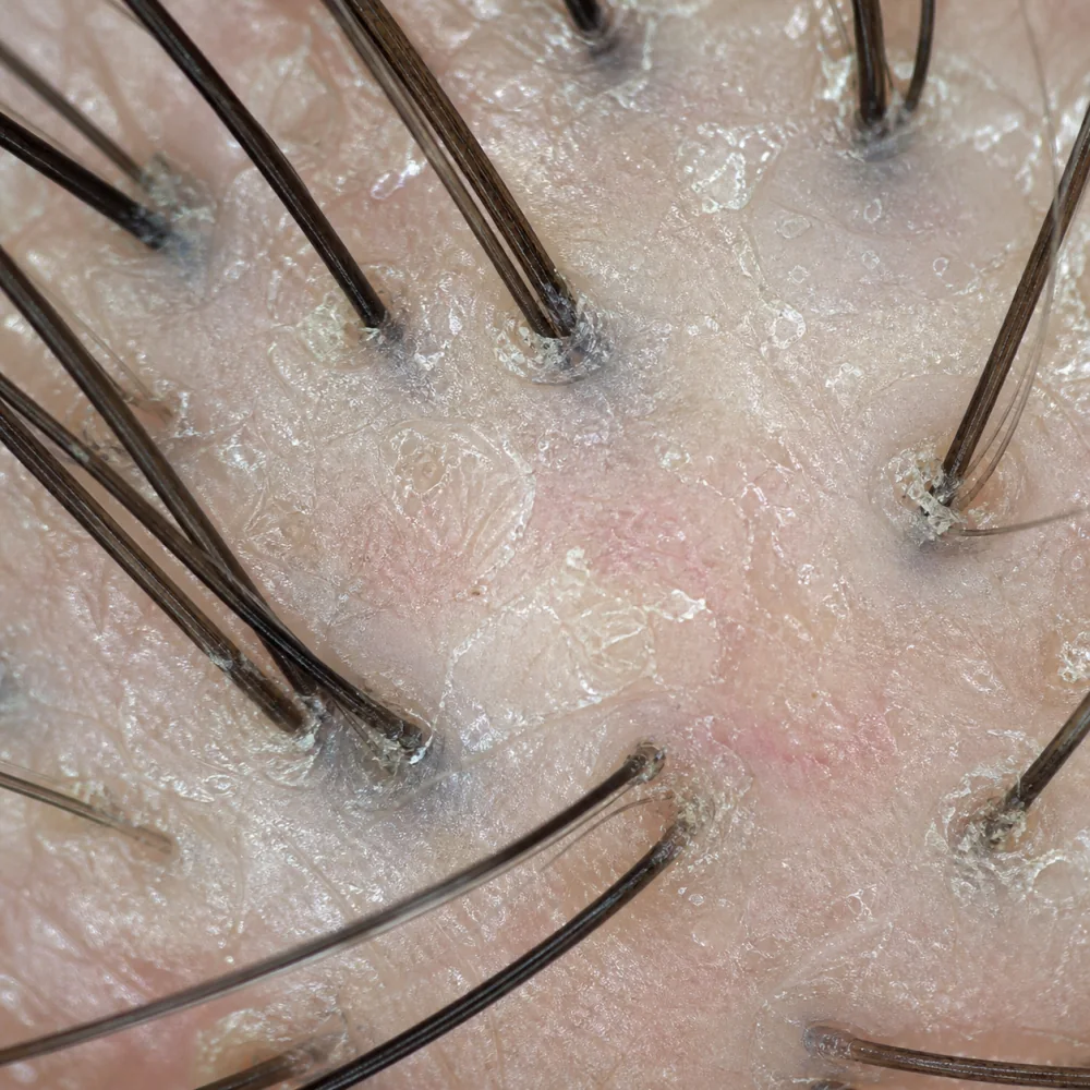 Illustrative before view of a scalp under 200x magnification